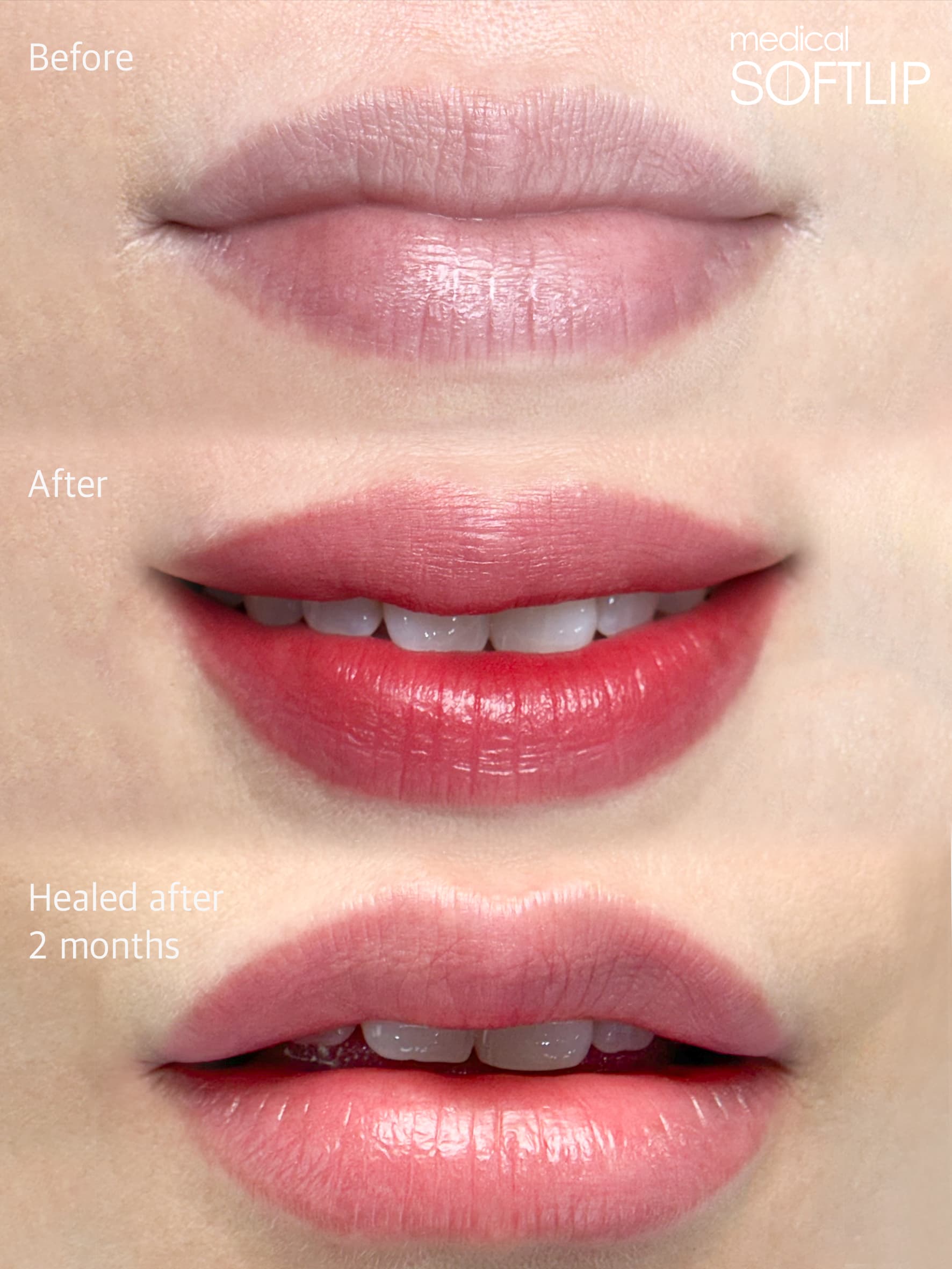 톤업 바비라인으로