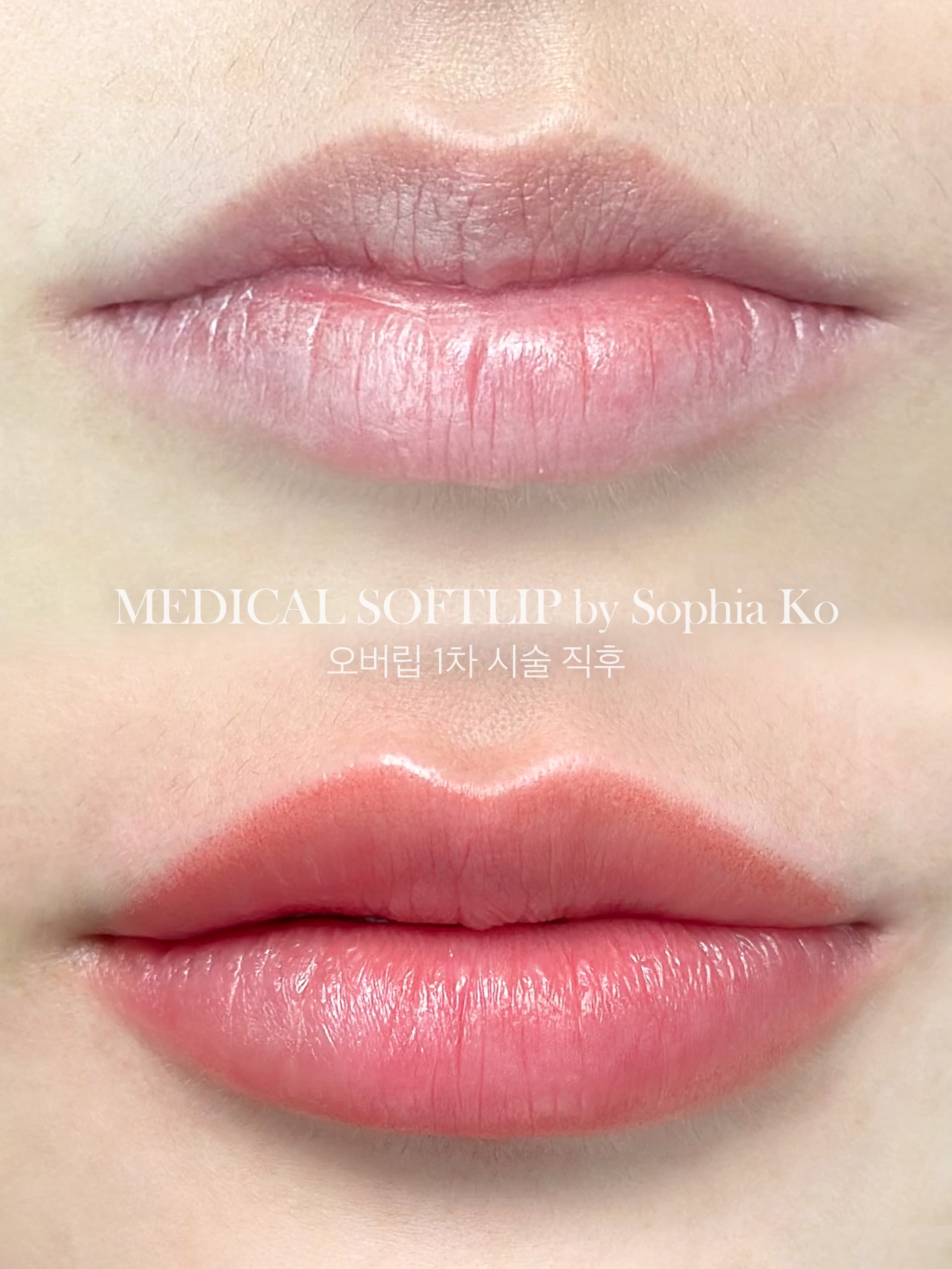 얇아 보이던 입술의 콤플렉스