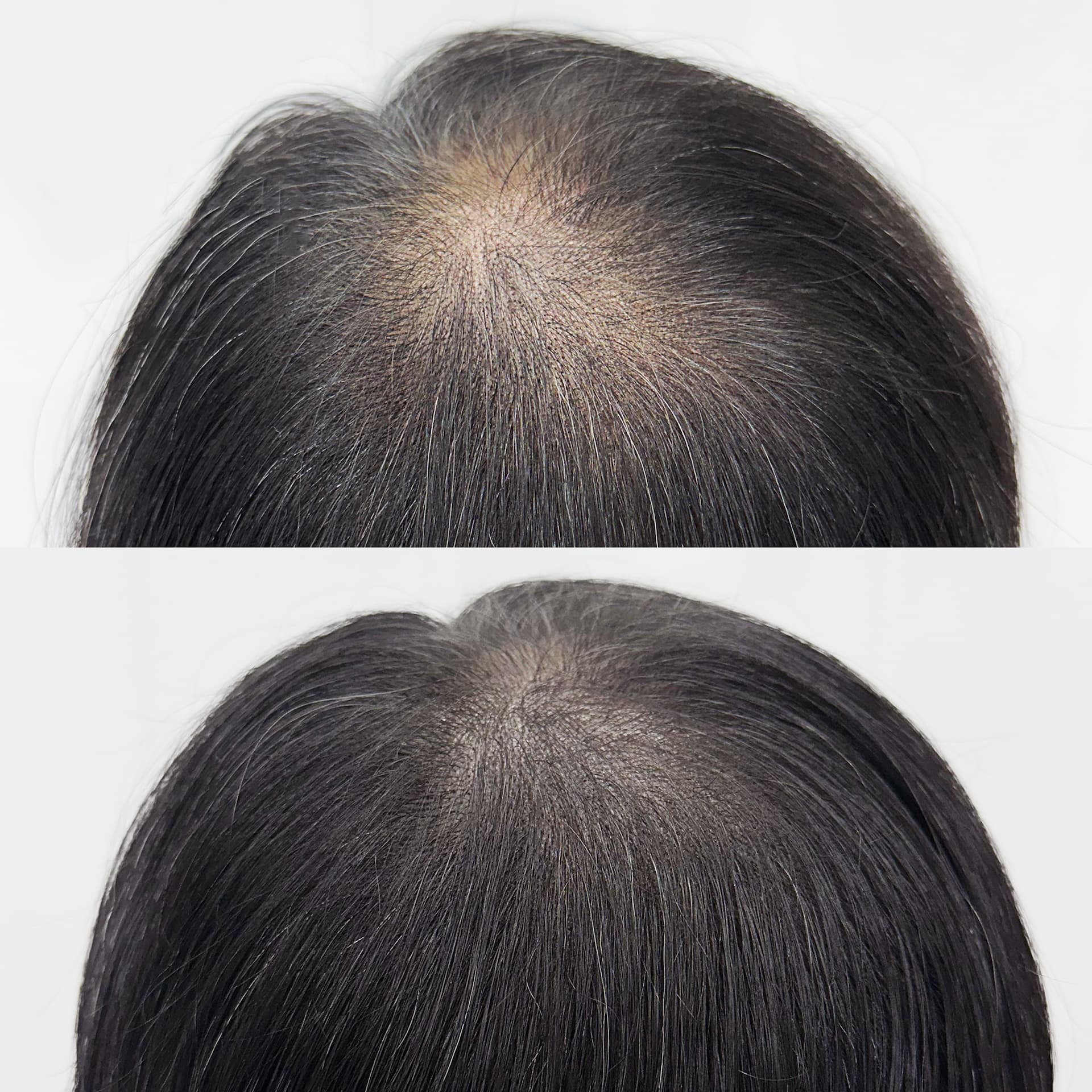 헤어라인부터 정수리까지